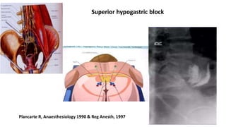 Superior hypogastric block
Plancarte R, Anaesthesiology 1990 & Reg Anesth, 1997
 