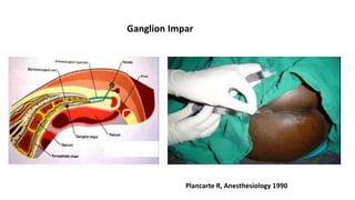 Ganglion Impar
Plancarte R, Anesthesiology 1990
 