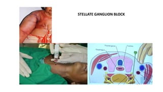 STELLATE GANGLION BLOCK
 