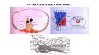 ANTEROCRURAL Vs RETROCRURAL SPREAD
 