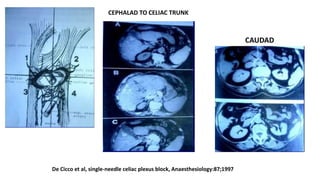 CEPHALAD TO CELIAC TRUNK
CAUDAD
De Cicco et al, single-needle celiac plexus block, Anaesthesiology:87;1997
 