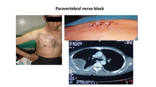 Paravertebral nerve block
 