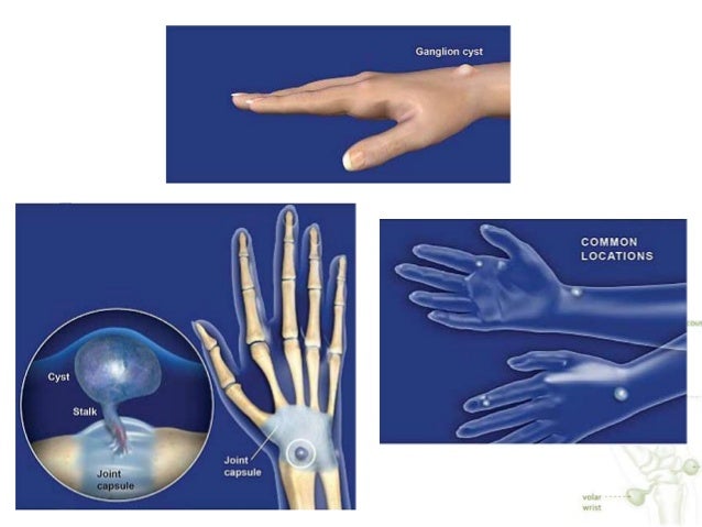 Ganglion cyst