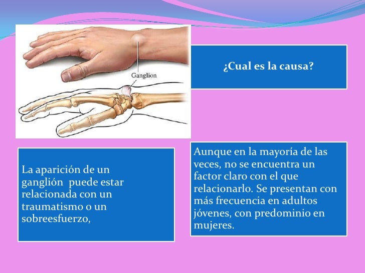 Ganglion de muñeca