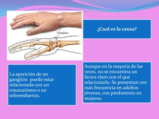 ¿Cual es la causa?




                       Aunque en la mayoría de las
                       veces, no se encuentra un
La aparición de un
                       factor claro con el que
ganglión puede estar
                       relacionarlo. Se presentan con
relacionada con un
                       más frecuencia en adultos
traumatismo o un
                       jóvenes, con predominio en
sobreesfuerzo,
                       mujeres.
 
