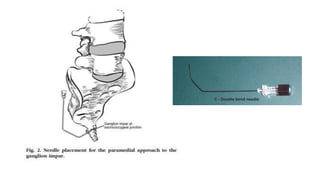 Par Inpar Block Ganglion Impar Block- Dr Minhaj Akhter ppt.pdf