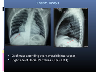 Chest Xrays
 Oval mass extending over several rib interspaces
 Right side of Dorsal Vertebras. ( D7 - D11)
 