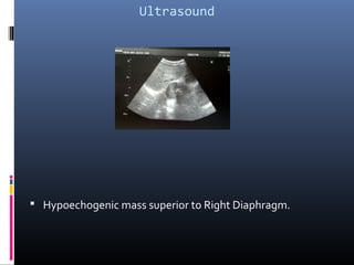 Ultrasound
 Hypoechogenic mass superior to Right Diaphragm.
 