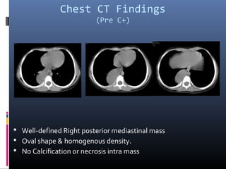 Chest CT Findings
(Pre C+)
 Well-defined Right posterior mediastinal mass
 Oval shape & homogenous density.
 No Calcification or necrosis intra mass
 