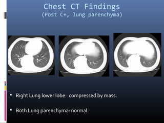 Chest CT Findings
(Post C+, lung parenchyma)
 Right Lung lower lobe: compressed by mass.
 Both Lung parenchyma: normal.
 