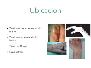 Ubicación
• Tendones del extensor corto
mano
• Tendones extensor dedo
índice
• Túnel del Carpo
• Cara palmar