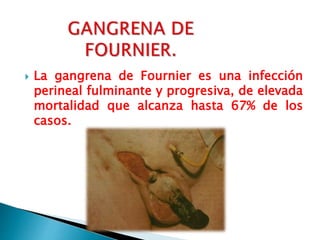 Fournierova Gangrena Fournier s Gangrene Causes Symptoms Diagnosis fournierova-gangrena-fournier-s-gangrene-causes-symptoms-diagnosis