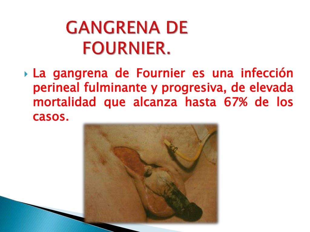 Gangrena de fournier
