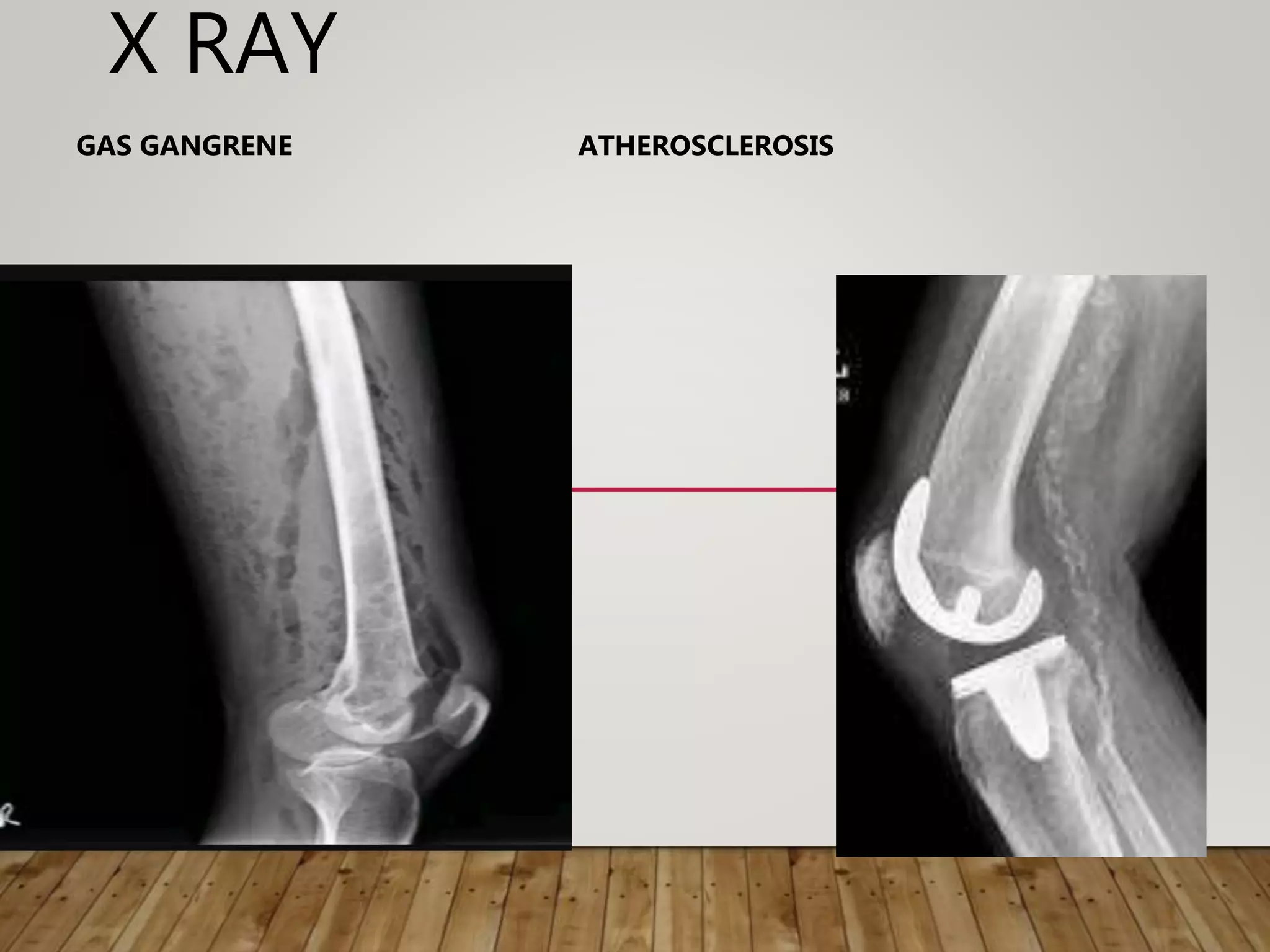 X RAY
GAS GANGRENE ATHEROSCLEROSIS
 