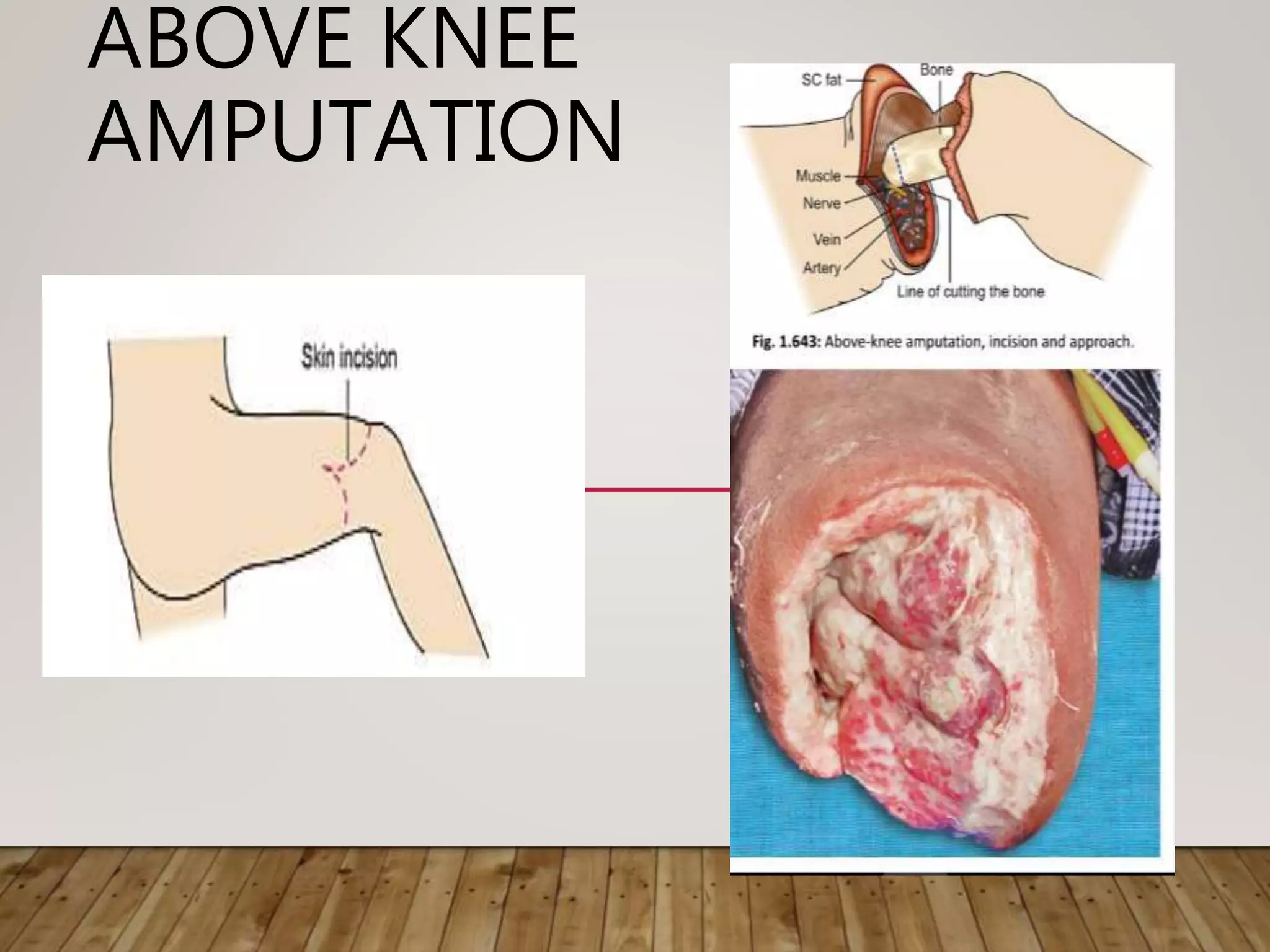 ABOVE KNEE
AMPUTATION
 