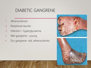 DIABETIC GANGRENE
1. Atherosclerosis
2. Peripheral neuritis
3. Infection – hyperglycaemia
• Wet gangrene – young
• Dry gangrene- old, atherosclerotic
 