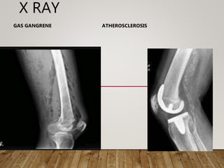 X RAY
GAS GANGRENE ATHEROSCLEROSIS
 