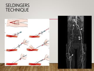 SELDINGERS
TECHNIQUE
 