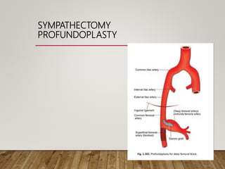 SYMPATHECTOMY
PROFUNDOPLASTY
 