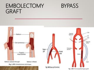 EMBOLECTOMY BYPASS
GRAFT
 