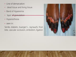 • Line of demarcation:
• dead tissue and living tissue.
• Band of Hyperemia
• layer of granulation
• Hyperesthesia
• seen in:
Senile, diabetic, buerger’s , raynaud’s, frost
bite, vascular occlusion, embolism, ligation
 