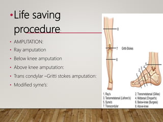 •Life saving
procedure:
• AMPUTATION:
• Ray amputation
• Below knee amputation
• Above knee amputation:
• Trans condylar –Gritti stokes amputation:
• Modified syme’s:
 