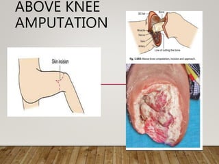 ABOVE KNEE
AMPUTATION
 