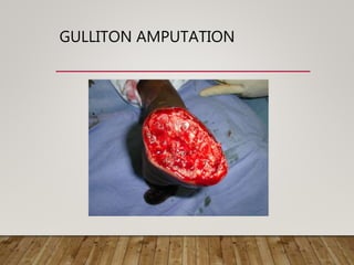 GULLITON AMPUTATION
 
