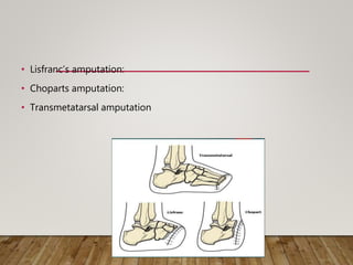 • Lisfranc’s amputation:
• Choparts amputation:
• Transmetatarsal amputation
 