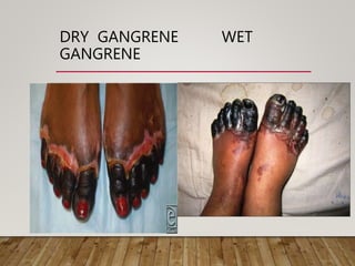 DRY GANGRENE WET
GANGRENE
 