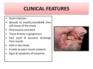 CLINICAL FEATURES
• Tooth infection
• Spreads to maxilla,mandible& then
soft tissue of the cheek.
• Oral mucosa ulcerated
• Tissue & bone is gangrenous
• Foul smell & purulent discharge
from mouth.
• Hole in the cheek.
• Unable to open mouth properly.
• Signs & symptoms of toxaemia.
 