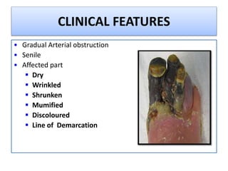 CLINICAL FEATURES
• Gradual Arterial obstruction
• Senile
• Affected part
 Dry
 Wrinkled
 Shrunken
 Mumified
 Discoloured
 Line of Demarcation
 