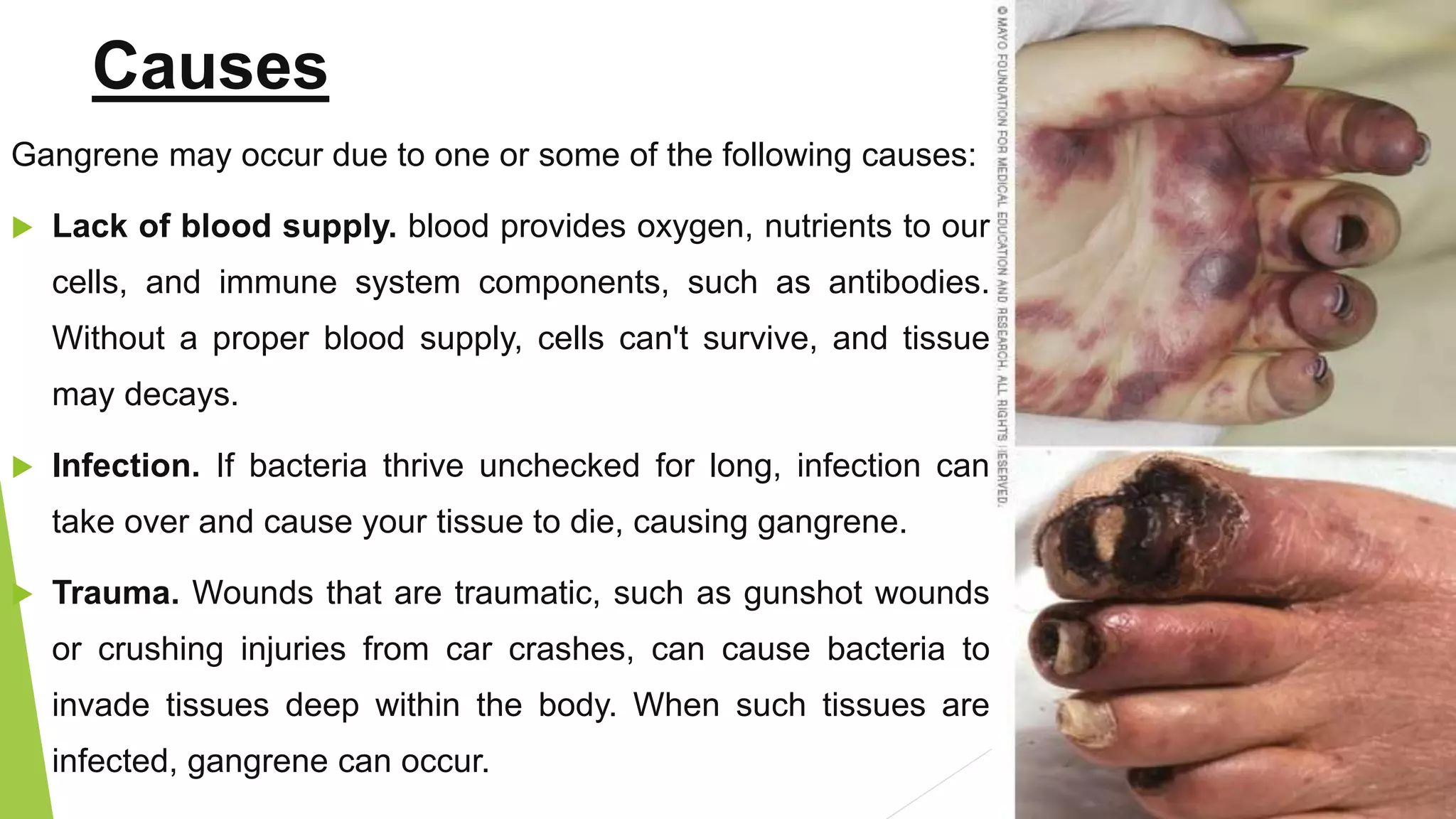 Gangrene | PPTX, image size:2048x1152