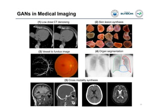 GANs in Medical Imaging
24
(5) Cross modality synthesis
(3) Vessel to fundus image
(2) Skin lesion synthesis(1) Low dose CT denoising
(4) Organ segmentation
 