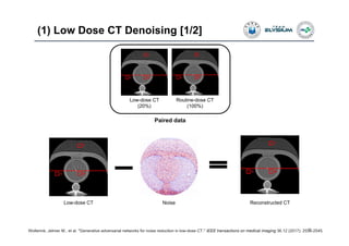 (1) Low Dose CT Denoising [1/2]
26Wolterink, Jelmer M., et al. "Generative adversarial networks for noise reduction in low-dose CT." IEEE transactions on medical imaging 36.12 (2017): 2536-2545.
Routine-dose CT
(100%)
Low-dose CT
(20%)
Paired data
Noise Reconstructed CTLow-dose CT
 