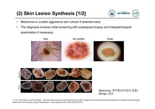 (2) Skin Lesion Synthesis [1/2]
28
Yi, Xin, Ekta Walia, and Paul Babyn. "Unsupervised and semi-supervised learning with Categorical Generative Adversarial Networks assisted by Wasserstein
distance for dermoscopy image Classification." arXiv preprint arXiv:1804.03700 (2018).
Melanoma: 흑색종(피부암의 일종)
Benign: 양성
Hair Air bubble Ruler
• Melanoma is curable aggressive skin cancer if detected early.
• The diagnosis involves initial screening with subsequent biopsy and histopathological
examination if necessary.
 