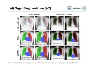 (4) Organ Segmentation [2/2]
33
JSRT (4 labels)
Dai, Wei, et al. "Scan: Structure correcting adversarial network for chest x-rays organ segmentation." arXiv preprint arXiv:1703.08770 (2017).
Montgomery (3 labels)
 