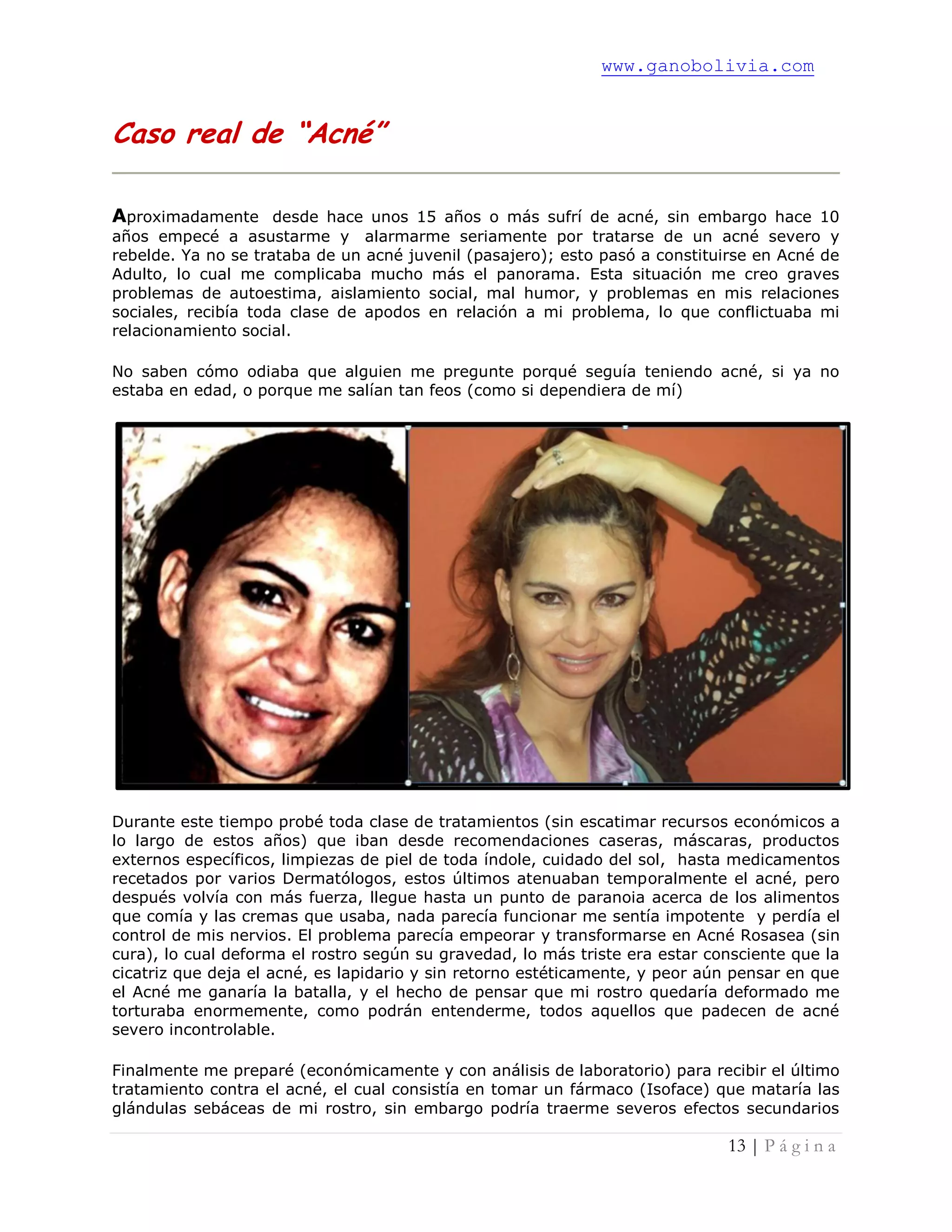 www.ganobolivia.com
13 | P á g i n a
Caso real de “Acné”
Aproximadamente desde hace unos 15 años o más sufrí de acné, sin embargo hace 10
años empecé a asustarme y alarmarme seriamente por tratarse de un acné severo y
rebelde. Ya no se trataba de un acné juvenil (pasajero); esto pasó a constituirse en Acné de
Adulto, lo cual me complicaba mucho más el panorama. Esta situación me creo graves
problemas de autoestima, aislamiento social, mal humor, y problemas en mis relaciones
sociales, recibía toda clase de apodos en relación a mi problema, lo que conflictuaba mi
relacionamiento social.
No saben cómo odiaba que alguien me pregunte porqué seguía teniendo acné, si ya no
estaba en edad, o porque me salían tan feos (como si dependiera de mí)
Durante este tiempo probé toda clase de tratamientos (sin escatimar recursos económicos a
lo largo de estos años) que iban desde recomendaciones caseras, máscaras, productos
externos específicos, limpiezas de piel de toda índole, cuidado del sol, hasta medicamentos
recetados por varios Dermatólogos, estos últimos atenuaban temporalmente el acné, pero
después volvía con más fuerza, llegue hasta un punto de paranoia acerca de los alimentos
que comía y las cremas que usaba, nada parecía funcionar me sentía impotente y perdía el
control de mis nervios. El problema parecía empeorar y transformarse en Acné Rosasea (sin
cura), lo cual deforma el rostro según su gravedad, lo más triste era estar consciente que la
cicatriz que deja el acné, es lapidario y sin retorno estéticamente, y peor aún pensar en que
el Acné me ganaría la batalla, y el hecho de pensar que mi rostro quedaría deformado me
torturaba enormemente, como podrán entenderme, todos aquellos que padecen de acné
severo incontrolable.
Finalmente me preparé (económicamente y con análisis de laboratorio) para recibir el último
tratamiento contra el acné, el cual consistía en tomar un fármaco (Isoface) que mataría las
glándulas sebáceas de mi rostro, sin embargo podría traerme severos efectos secundarios
 