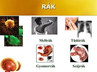 RÁK




 Mellrák    Tüdőrák




Gyomorrák   Szájrák
 