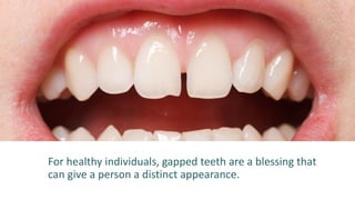 For healthy individuals, gapped teeth are a blessing that
can give a person a distinct appearance.
 