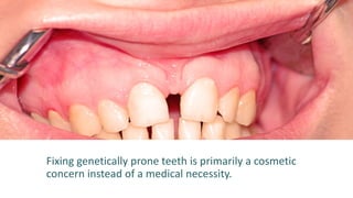 Fixing genetically prone teeth is primarily a cosmetic
concern instead of a medical necessity.
 