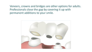 Veneers, crowns and bridges are other options for adults.
Professionals close the gap by covering it up with
permanent additions to your smile.
 