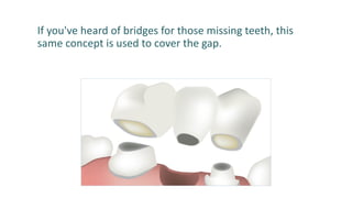 If you've heard of bridges for those missing teeth, this
same concept is used to cover the gap.
 