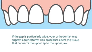 If the gap is particularly wide, your orthodontist may
suggest a frenectomy. This procedure alters the tissue
that connects the upper lip to the upper jaw.
 