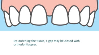 By loosening the tissue, a gap may be closed with
orthodontia gear.
 