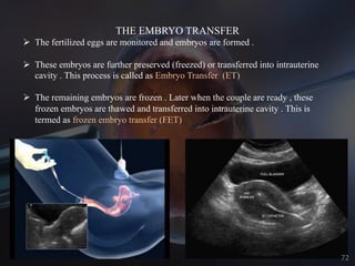 THE EMBRYO TRANSFER
Ø The fertilized eggs are monitored and embryos are formed .
Ø These embryos are further preserved (freezed) or transferred into intrauterine
cavity . This process is called as Embryo Transfer (ET)
Ø The remaining embryos are frozen . Later when the couple are ready , these
frozen embryos are thawed and transferred into intrauterine cavity . This is
termed as frozen embryo transfer (FET)
72
 