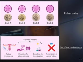 Fate of non used embryos
Embryo grading
75
 