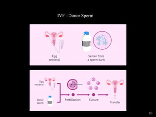 IVF –Donor Sperm
80
 