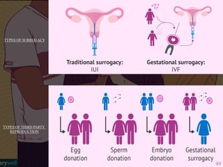 TYPES OF SURROGACY
TYPES OF THIRD PARTY
REPRODUCTION
89
 