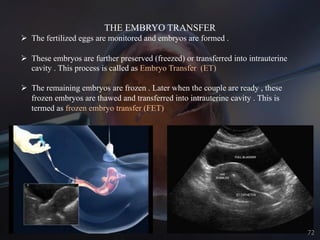 THE EMBRYO TRANSFER
Ø The fertilized eggs are monitored and embryos are formed .
Ø These embryos are further preserved (fr...